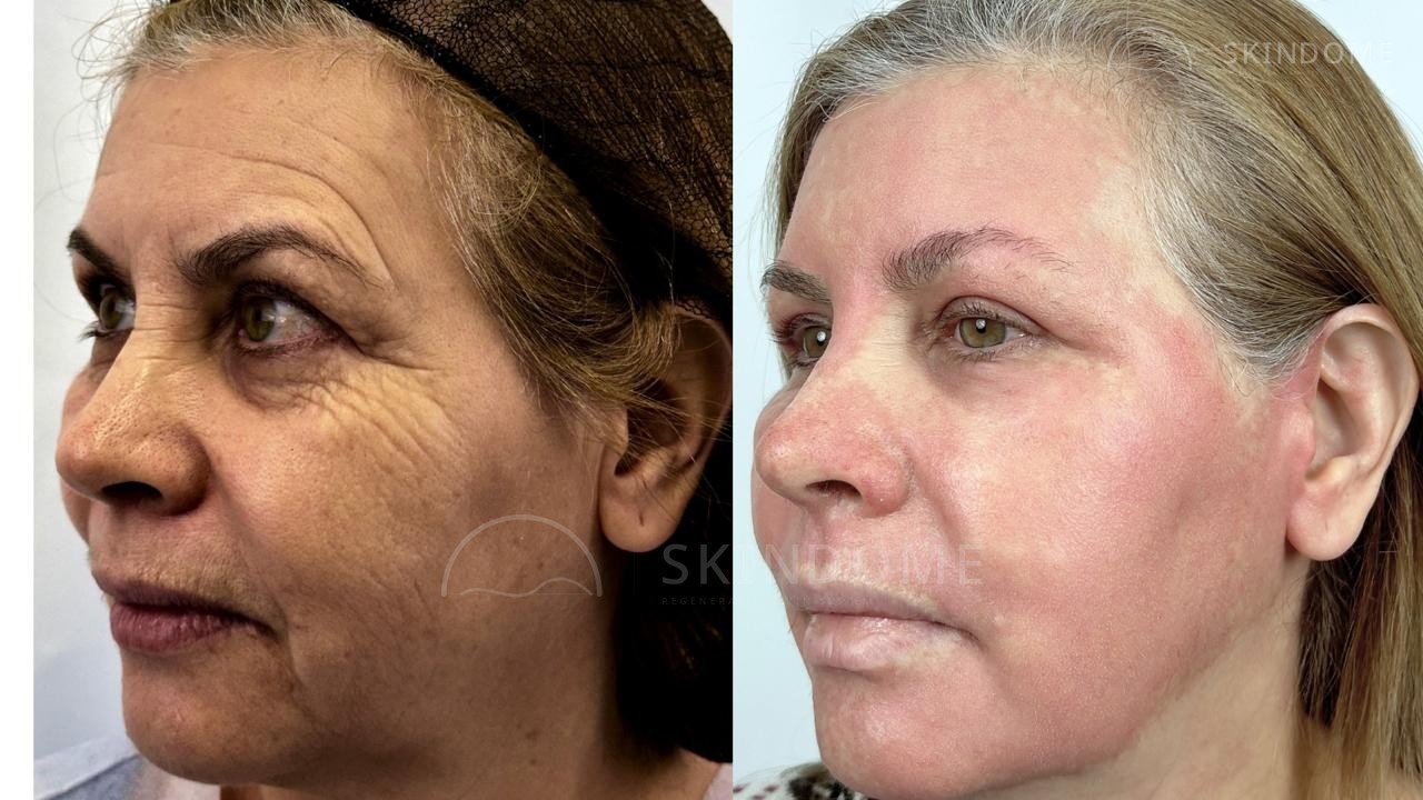Registro comparativo de caso clínico SkinDome