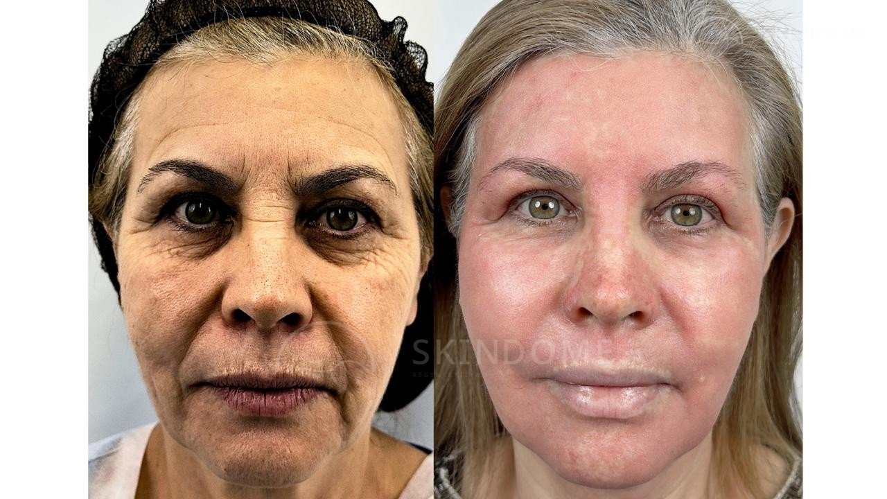 Caso clínico 06 SkinDome