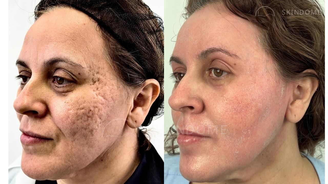 Registro comparativo de caso clínico SkinDome