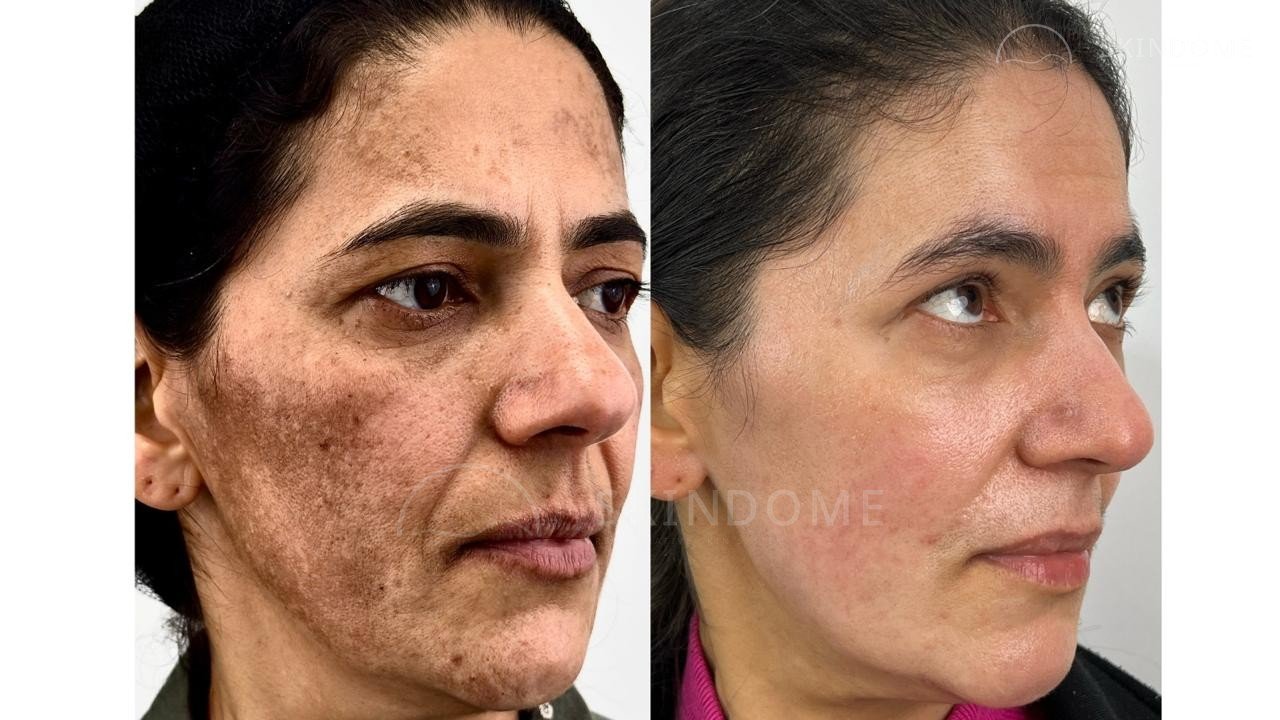 Caso clínico 03 SkinDome