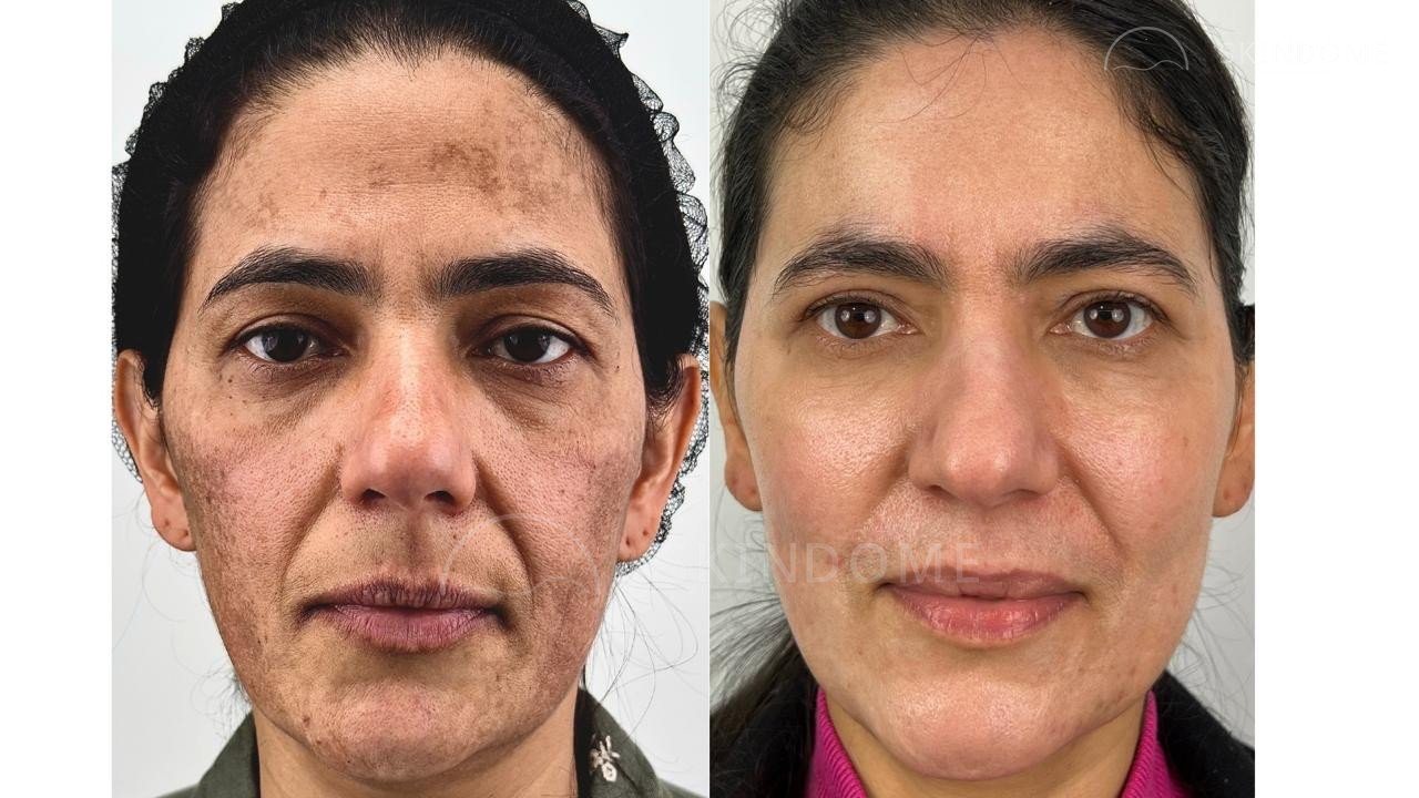 Caso clínico 04 SkinDome