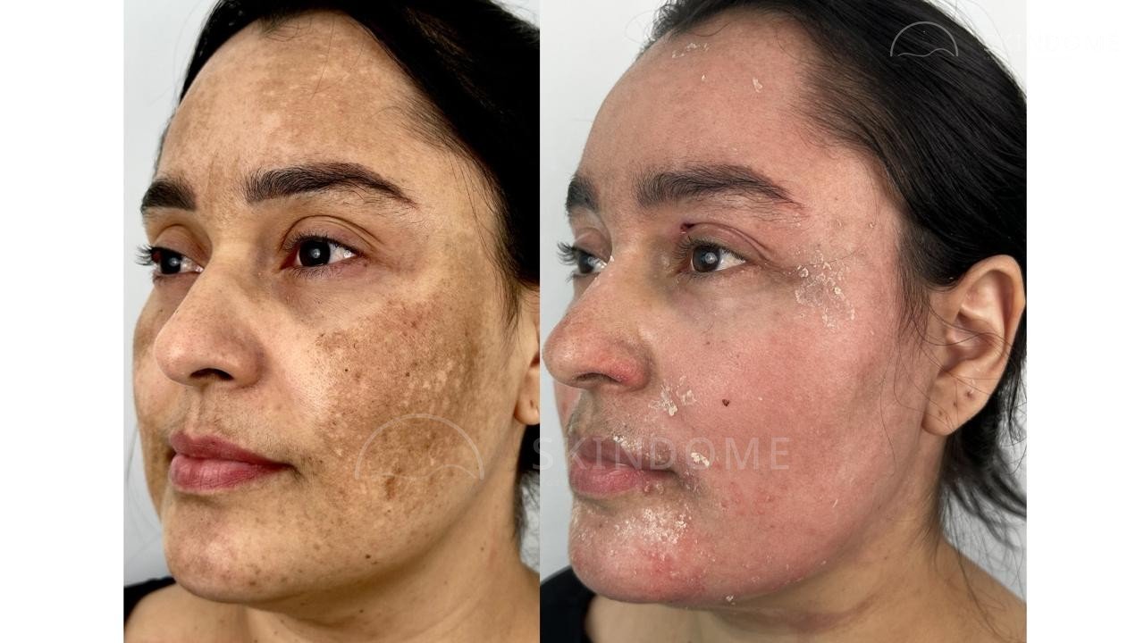 Caso clínico 11 SkinDome